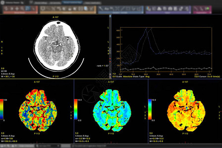 脑部的CT扫描图像3D在屏幕监视器上图片