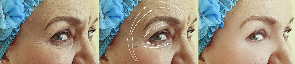 老年妇女在治疗前后和治疗前图片