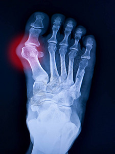 在大脚趾地区阿塔尔索法朗盖尔联合医院的X射线足部和关节图片