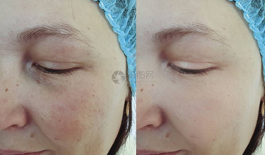 治疗前后的女人皱纹脸色素沉着图片
