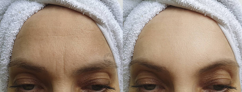 治疗前后女面部皱纹前额背景图片