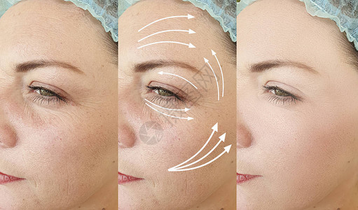 女人在治疗前后脸上的皱纹箭头图片