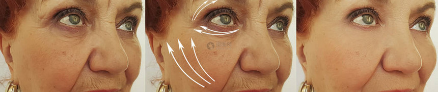 老妇人在治疗前后皱纹脸上图片