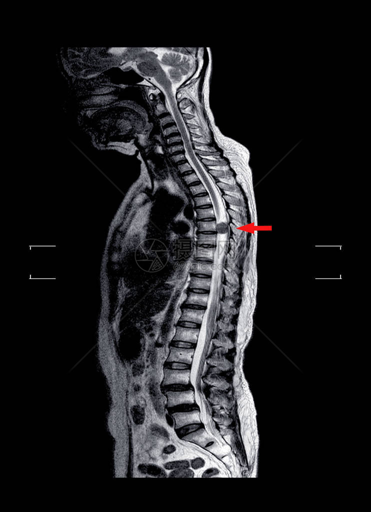 MRITL脊椎图片