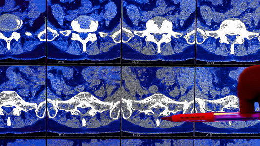 医生分析慢背痛患者人体脊柱的计算机断层扫描或CT成像结果图片