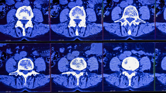 医生分析慢背部疼痛病人的类脊椎计算机断层造影结果图片