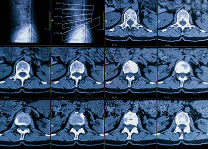慢背部疼痛病人的类脊椎的计算机断层摄影或CT成像结果显示脊椎腰膜纤维化和神经根压缩的退化变单背景图片