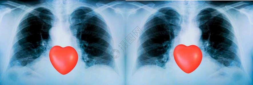 病人肺部的一组X光片图片