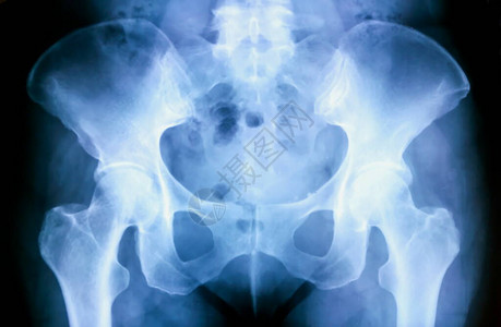 X光骨盆图片