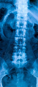 椎管人体下腰椎部分骨骼的X光片背景