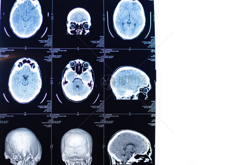 脑部核磁共振人类健康X射线图像MRI扫描或头部和脑部扫描的磁共振图图片