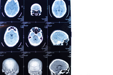 脑部核磁共振人类健康X射线图像MRI扫描或头部和脑部扫描的磁共振图图片
