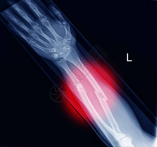 X射线图像显示骨折半径和软体组织在红科图片