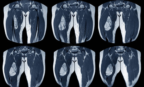 右大腿磁共振成像图片