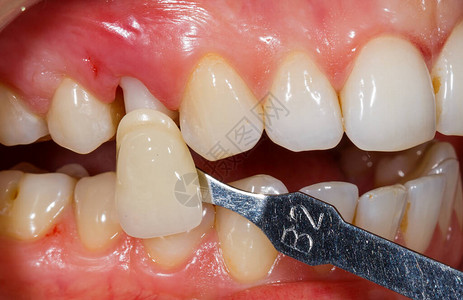 牙科诊所牙齿树荫镜图片