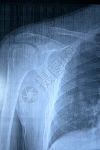 病人肺部X光健康和医图片