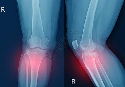 线膝关节胫骨近端干骺端骨折胫骨外侧平台凹陷骨折红点软组织严重肿胀图片