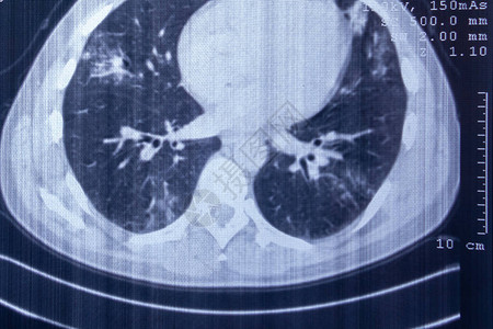 指示性概念图受影响的肺部X光片CT扫描背景