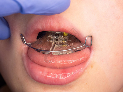 男孩在他的舌头上展示带有不锈钢丝的丙烯酸牙套在儿童牙齿上设置临时牙套男孩微笑的嘴背景图片