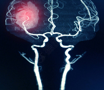 MRA大脑或出血中脑动脉的磁共振动脉图图片