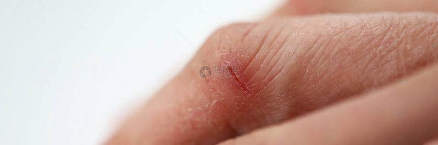人手切割的特写镜头干裂的皮肤手指上的伤口和裂缝皮肤病受了轻伤手部护肤品皮肤病图片