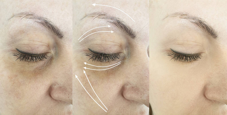 女人在治疗前后脸上的皱纹箭头图片