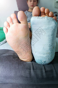 细节脚白色石膏中的左腿或脚石膏中的断腿男孩图片