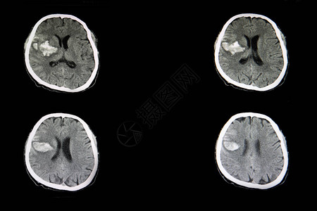 对急出血中风的病人进行CT扫描图片
