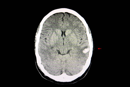 对一个因车祸而出血的脑部进行CT扫描图片