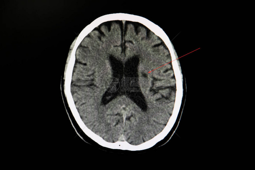 一个中风病人的CT扫描脑部显示拉库纳尔在左冠状图片