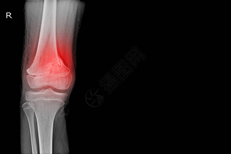 膝关节X射线在红色标记和黑色背景上显示股骨远端骨折图片