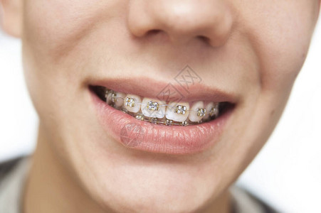 牙齿上的牙套关闭了牙套上的金属丝弯曲了隔离图片