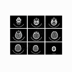 大脑计算机断层扫描的X射线图像背景图片