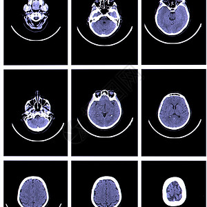 大脑计算机断层扫描的X射线图像背景图片