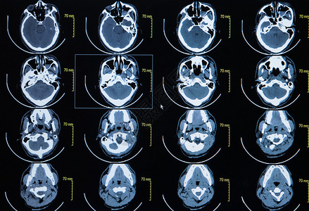 脑计算机断层成像图系列由脑部电图片