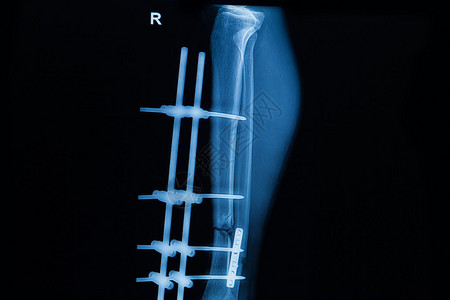 收集显示右腿骨折的人体X光片图片
