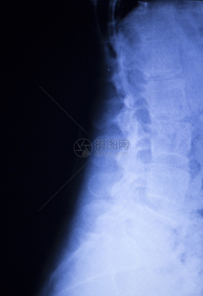 脊椎背部疼痛和颈部整形X光图片