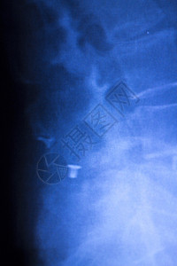 脊柱背部和颈部整形钛金属脊椎板图片