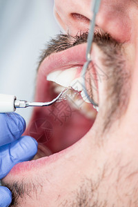 口腔微积分治疗粉背景图片