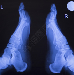 用于诊断受伤的脚趾脚跟和脚踝X射线创伤图片
