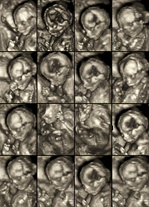 对怀孕4个月的女胎儿进行3D超声异常扫描的16幅医图片