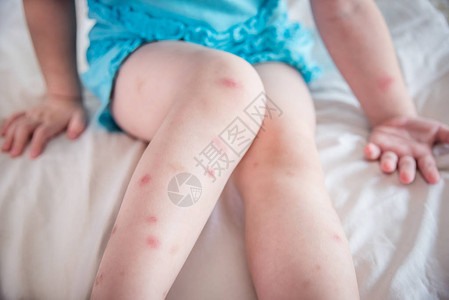 蚊虫叮咬痛和孩子腿上的伤疤图片