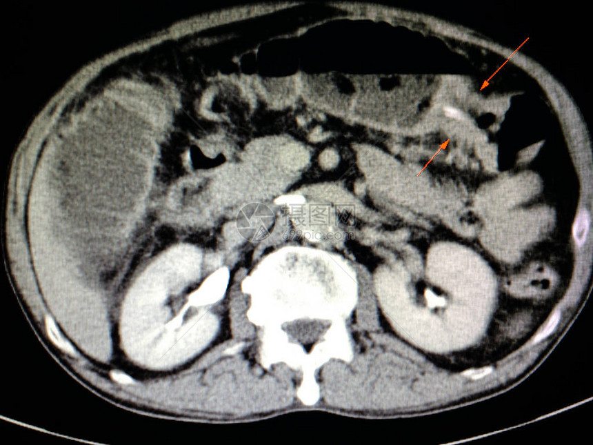 一名病人的横切肠癌患者的诊断计算机图片