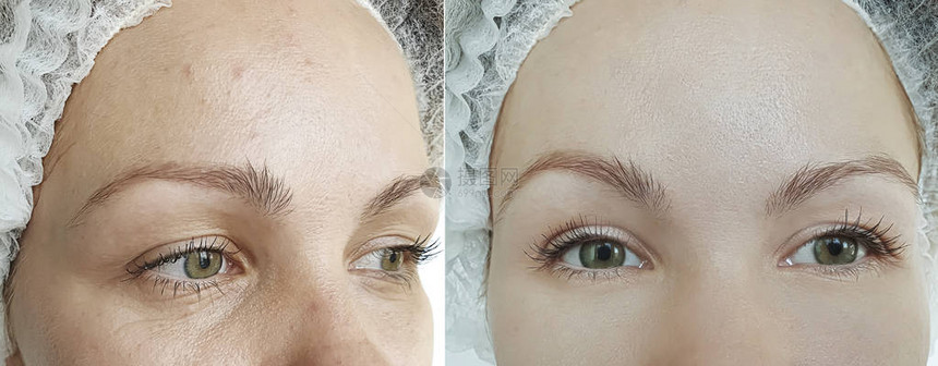 治疗前后的女人眼睛皱纹图片