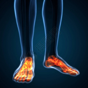 人体骨合力疼痛解剖脚和腿联合症3图片