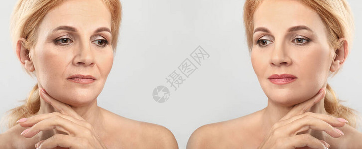 中年妇女在打光背景填充物注射前后的中年妇背景图片