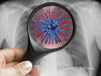 以肺胸X光上的细胞为焦点图片