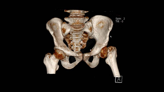 对显示左股骨颈折CTVRPelvis的骨盆进行心高清图片