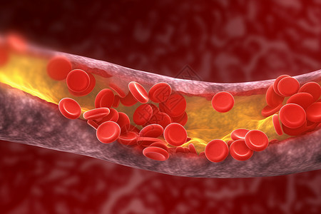 动脉中的胆固醇斑块医学概念3d效果图背景图片