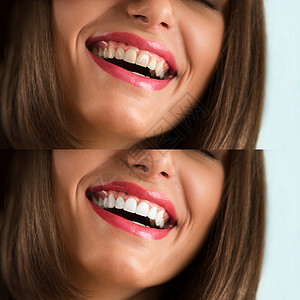 美白漂白治疗,前后,女人牙齿微笑,特写肖像背景图片